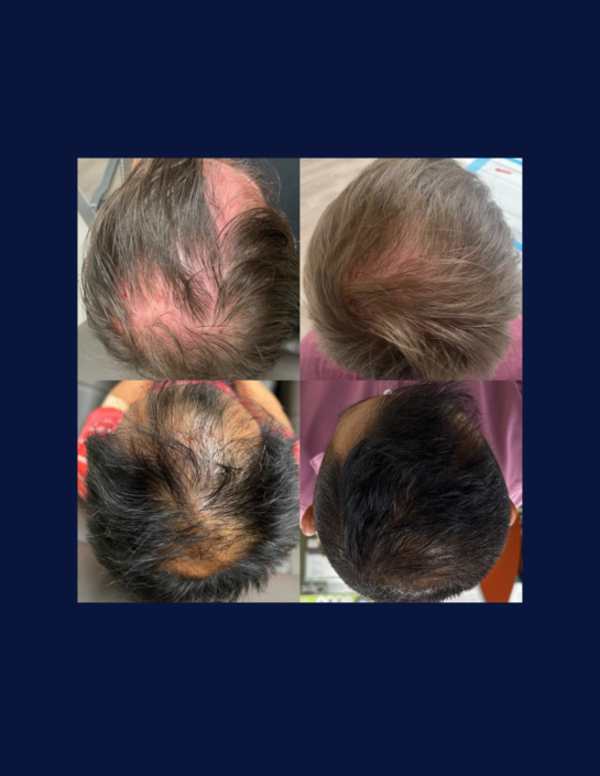 691f9bfe5bbf7f4f0dfa856d Before and after results of Miami hair restoration therapy with PRP injections show filled in bald spots for a fuller, thicker scalp.