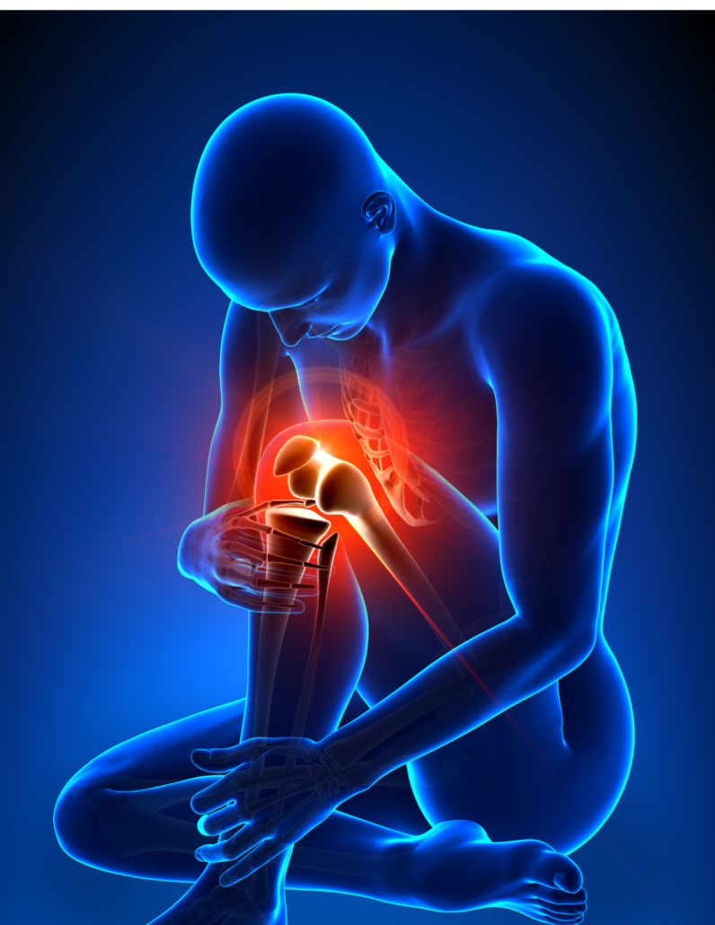 82d8597a-96f9-44d6-aca6-3f8e0b7ae8b1 Graphic depicting knee pain. Miami Stem Cell knee injection offer a non-surgical approach to pain relief for knees.